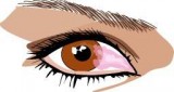 Pterygium